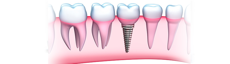  Demetevler Dış Doktoru , Demetevler  Implant Tedavisi,Dr.Mücahit Demirci | Implantoloji